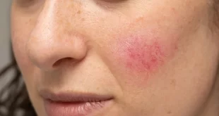 Bem Viver: estado emocional pode causar manchas vermelhas na pele
