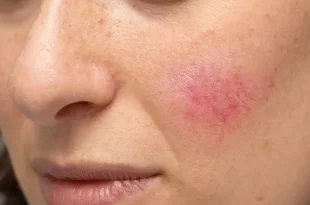 Bem Viver: estado emocional pode causar manchas vermelhas na pele