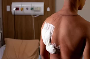 Hemorragia no ouvido e queimaduras: as sequelas que raio deixou em bolsonarista de 17 anos