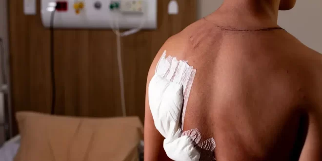 Hemorragia no ouvido e queimaduras: as sequelas que raio deixou em bolsonarista de 17 anos