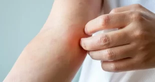 Surto de fungo sexual altamente contagioso preocupa Europa