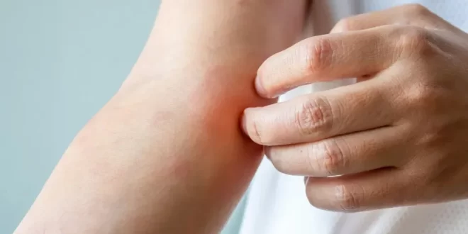 Surto de fungo sexual altamente contagioso preocupa Europa