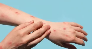 Brasil registra 48 casos de mpox nos primeiros meses de 2026