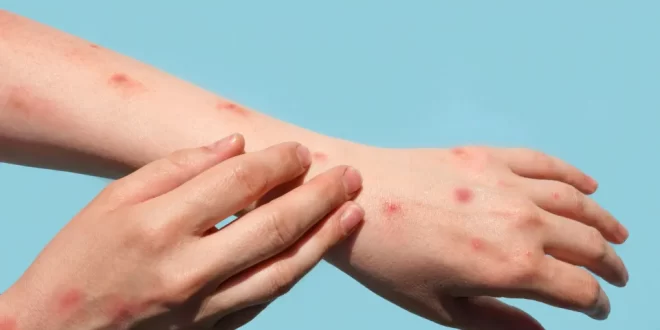Brasil registra 48 casos de mpox nos primeiros meses de 2026