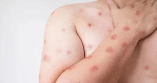 Brasil registra 180 notificações de Mpox