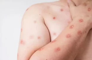 Brasil registra 180 notificações de Mpox