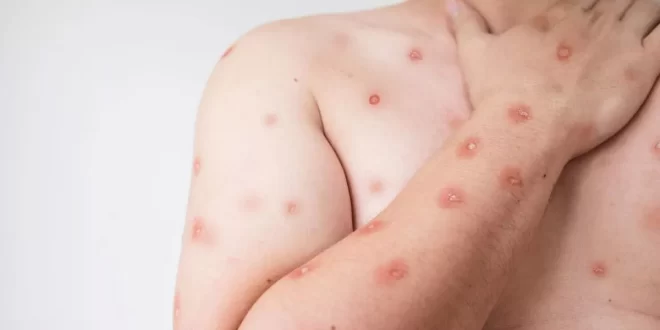 Brasil registra 180 notificações de Mpox