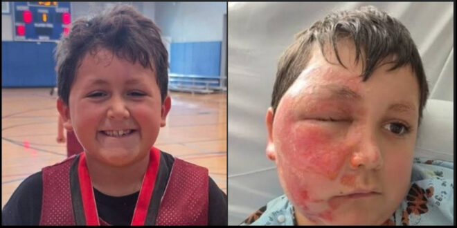 Alerta aos pais: menino faz desafio do TikTok e acaba com rosto desfigurado