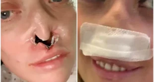 Deu ruim: mulher faz implante dentário e fica com buraco no rosto
