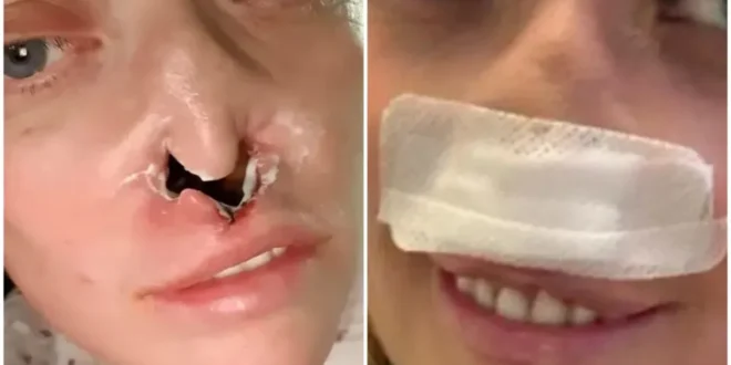 Deu ruim: mulher faz implante dentário e fica com buraco no rosto