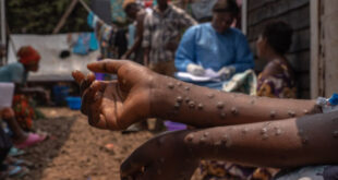 Alerta: Sesacre confirma caso de Mpox no Acre
