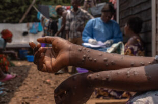 Alerta: Sesacre confirma caso de Mpox no Acre