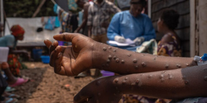 Alerta: Sesacre confirma caso de Mpox no Acre