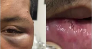 Violência política: homem é espancado em bar no MT após revelar que é petista