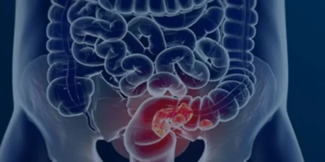 Veja seis sintomas que podem sinalizar o câncer de intestino em estágio inicial