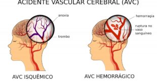 Hipercolesterolemia familiar: doença genética que faz com que o colesterol permaneça elevado desde o nascimento