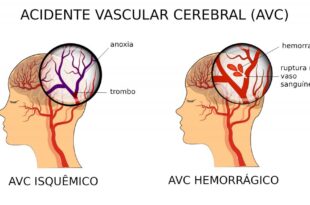 Hipercolesterolemia familiar: doença genética que faz com que o colesterol permaneça elevado desde o nascimento