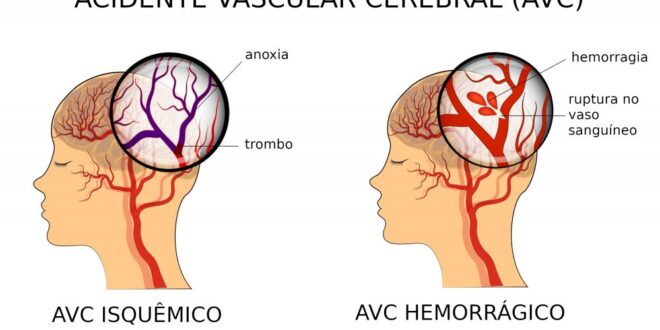 Hipercolesterolemia familiar: doença genética que faz com que o colesterol permaneça elevado desde o nascimento