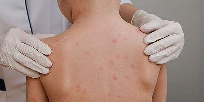 Meningite bacteriana atinge criança de 7 anos em escola de Cruzeiro do Sul; secretaria de saúde descarta bloqueio e mantém aulas