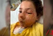 Menina de 10 anos sofre queimaduras no rosto após fazer desafio do TikTok