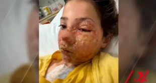 Menina de 10 anos sofre queimaduras no rosto após fazer desafio do TikTok