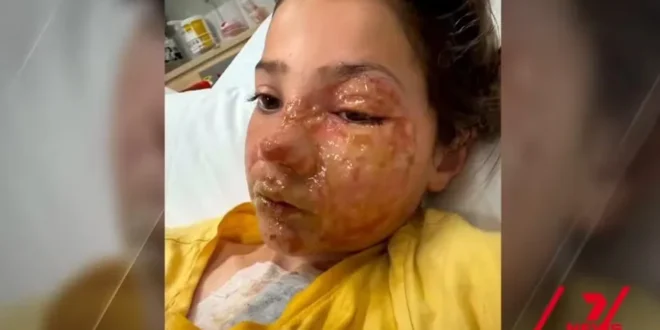 Menina de 10 anos sofre queimaduras no rosto após fazer desafio do TikTok