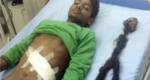 Rapaz que carregava o irmão gêmeo dentro do corpo foi submetido a uma cirurgia