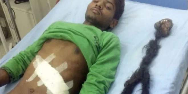 Rapaz que carregava o irmão gêmeo dentro do corpo foi submetido a uma cirurgia