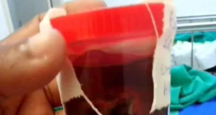 Menino de 13 anos perde testículo após agressão de colega em escola do Acre
