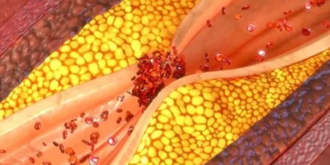 Bem Viver: veja quais alimentos podem ajudar a evitar o entupimento de veias e artérias