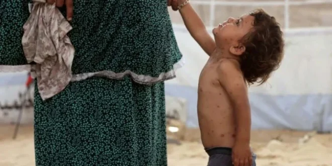Catapora se espalha pelos superlotados acampamentos de deslocados em Gaza