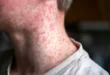 Surto nos EUA: sarampo mata duas pessoas não vacinadas 23 Surto nos EUA: sarampo mata duas pessoas não vacinadas