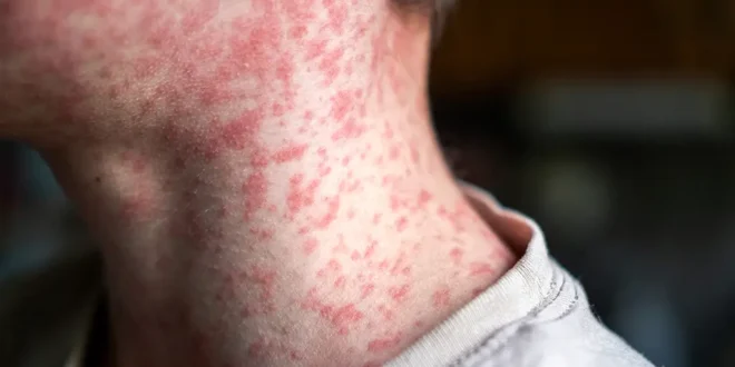 Surto nos EUA: sarampo mata duas pessoas não vacinadas