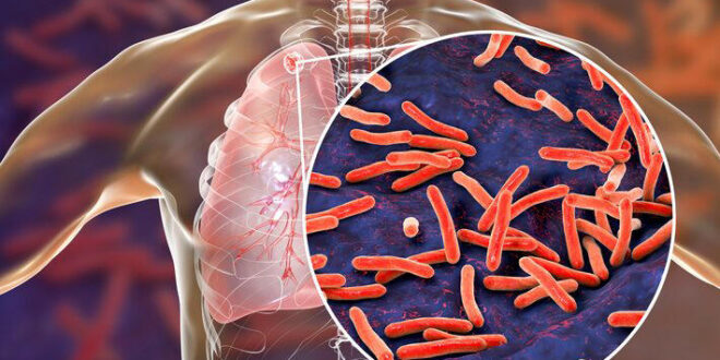 Em estado latente: milhões de pessoas são portadoras da bactéria causadora da tuberculose sem saber