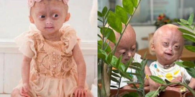 Morre uma das gêmeas com síndrome rara de envelhecimento precoce