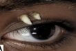 Bizarro: adolescente descobre dente crescendo no olho após inchaço na sobrancelha